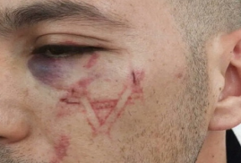 Filistinli gencin yüzüne metal bir alet ile 'Davud Yıldızı' kazıdılar